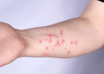 KTDTO’dan maymun çiçeği hastalığı konusunda uyarılar