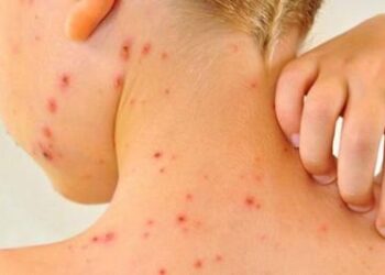 AVRUPA’DA KIZAMIK VAKALARI ARTIYOR