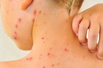 AVRUPA’DA KIZAMIK VAKALARI ARTIYOR