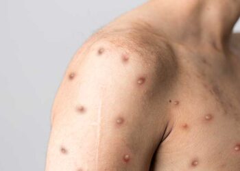 TABİPLER BİRLİĞİ’NDEN MAYMUN ÇİÇEĞİ UYARISI