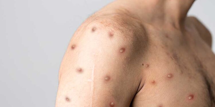 TABİPLER BİRLİĞİ’NDEN MAYMUN ÇİÇEĞİ UYARISI